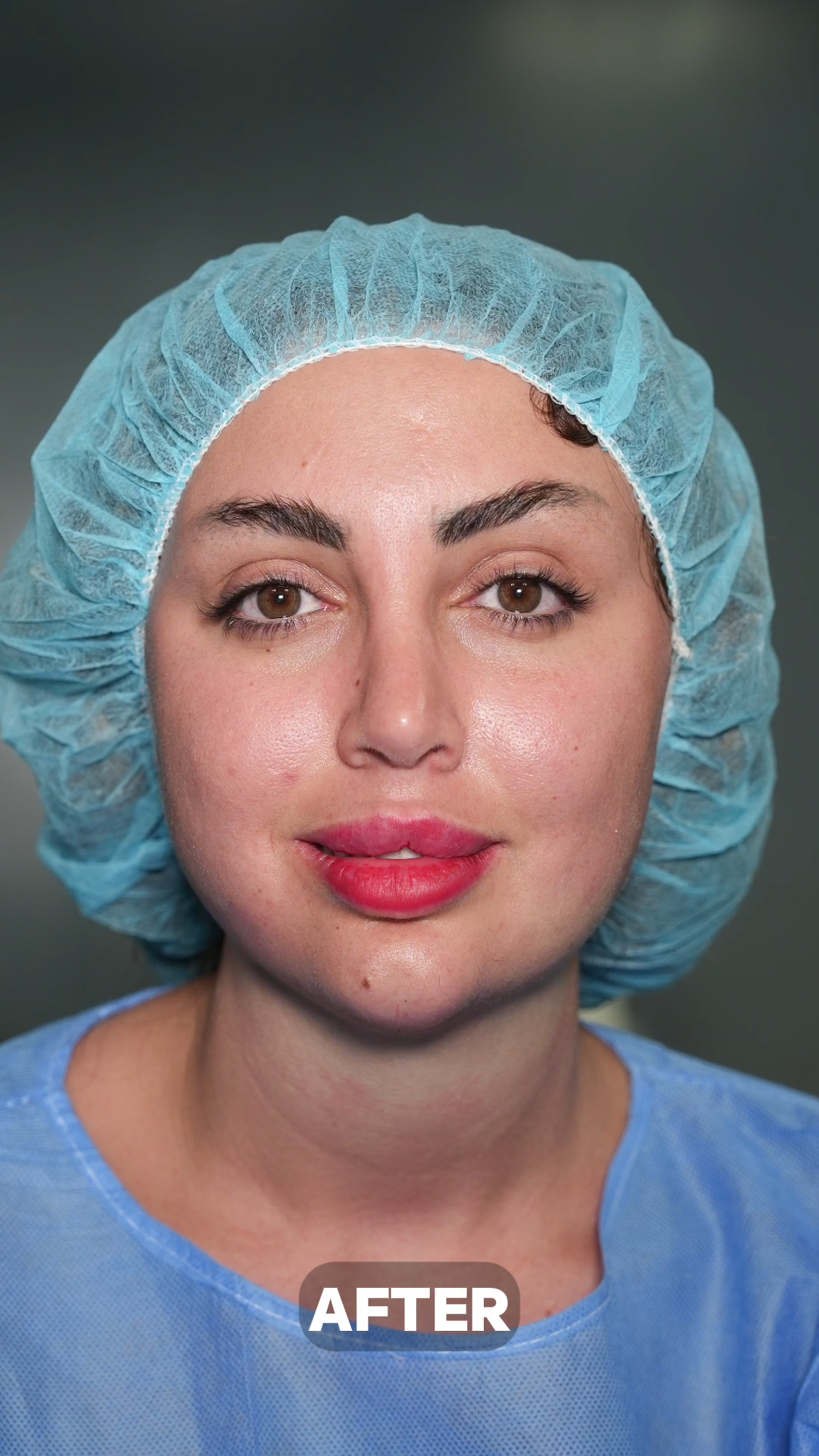 ✨ Chin Liposuction